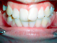 Dr. Ghilzon Orthodontics Case #2 - Before