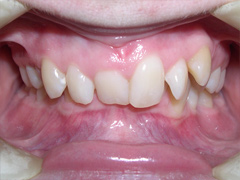 Dr. Ghilzon Orthodontics Case #3 - Before