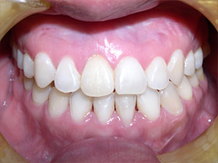 Dr. Ghilzon Orthodontics Case #5 - After